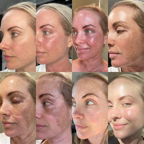 Elaine brennan peel - This group is for any Beauty Industry professionals, Doctors & Cosmetic Nurses wishing to learn more about The Elaine Brennan Skin Renewal Peeling System. Elaine Brennan Skin Renewal Peel Australia Group